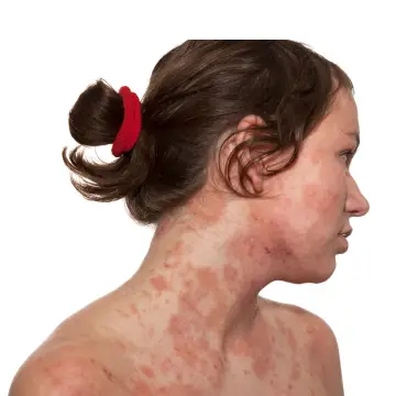 Dermatitis: Todo lo que debes saber